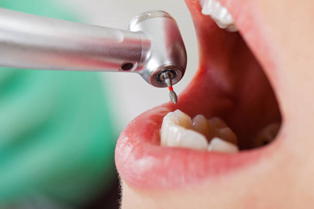 Best Emergency Root Canal Treatment in El Centro, CA